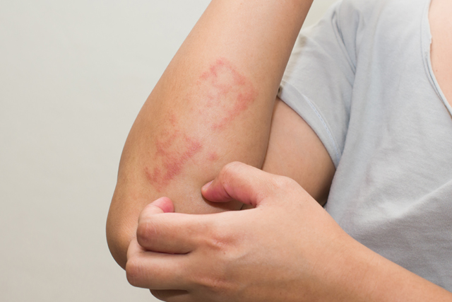 Treatment for Psoriasis, Causes and Triggers of Psoriasis