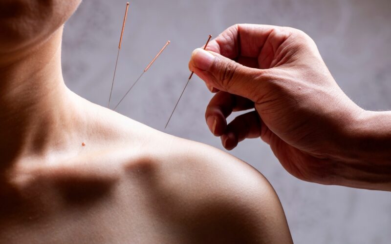 woman receiving acupunture