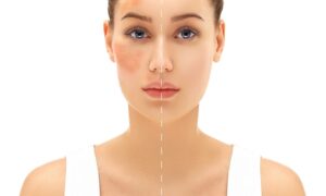 Dark spots and hyperpigmentation shown on a woman's face