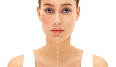 Dark spots and hyperpigmentation shown on a woman's face