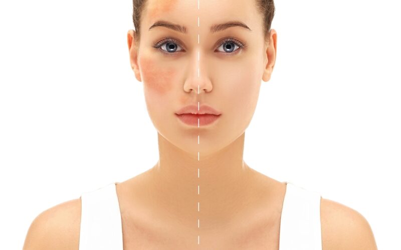 Dark spots and hyperpigmentation shown on a woman's face