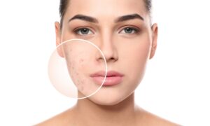 Up close of woman dealing with acne