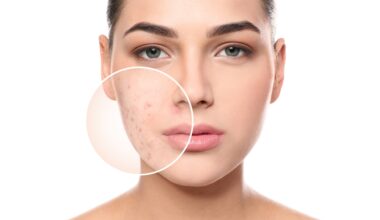 Up close of woman dealing with acne