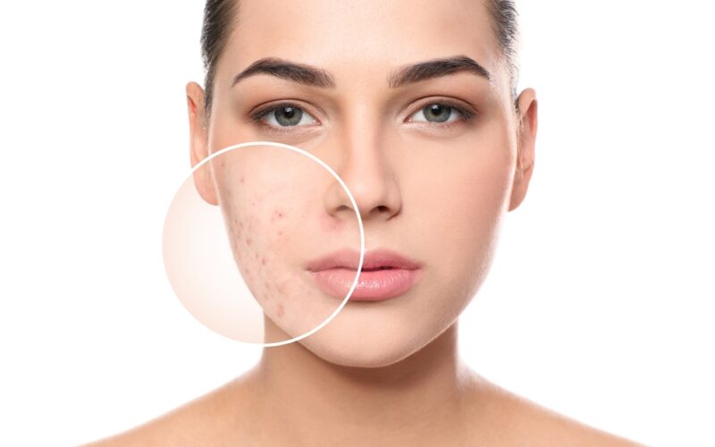 Up close of woman dealing with acne