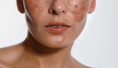 Hyperpigmentation shown up close on a female face