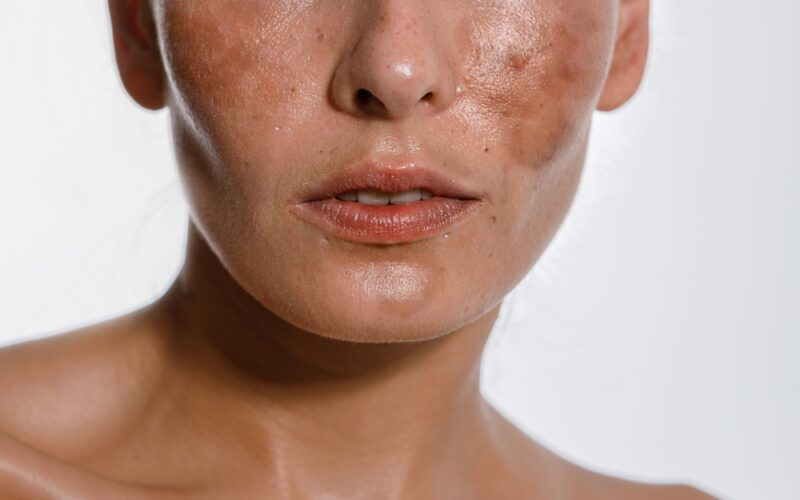 Hyperpigmentation shown up close on a female face