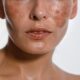 Hyperpigmentation shown up close on a female face