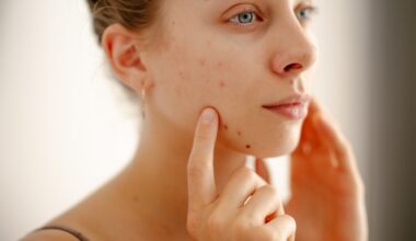 Up close shot of woman touching her face and dealing with acne