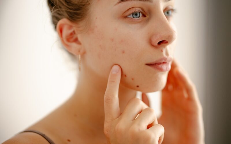 Up close shot of woman touching her face and dealing with acne