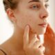 Up close shot of woman touching her face and dealing with acne